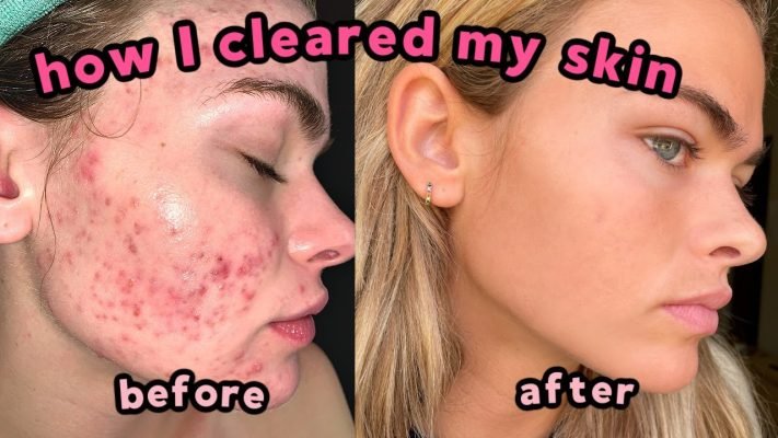 Accutane for acne