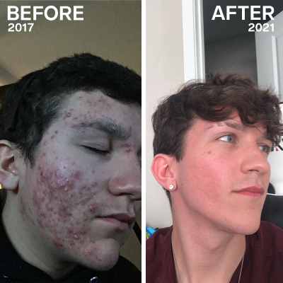 Accutane for acne
